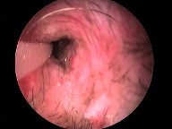 inside ear infection close up